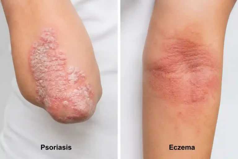 psoriasis vs eczema
