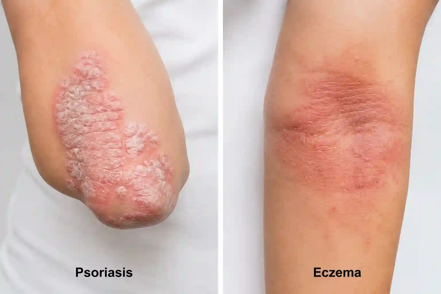 psoriasis vs eczema